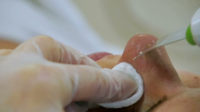 Cosmetologist Does The Nose Cleaning Close-up